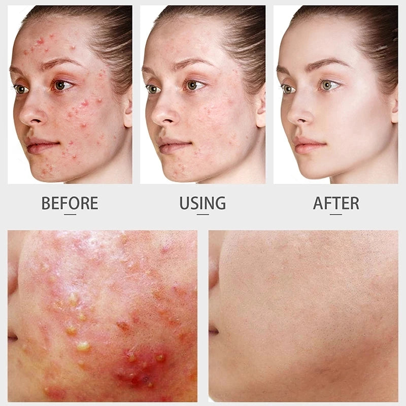 Sérum facial de chá verde Laikou, controle de oleosidade, antienvelhecimento, redução de poros, tratamento para acne, clareamento, hidratação, essência de melaleuca, cuidados com a pele