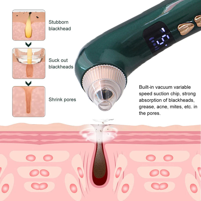 AOKO Removedor de Cravos, Câmera de Vácuo para Poros, Limpador de Poros, Removedor de Acne, Aquecimento Elétrico, Limpeza Profunda do Nariz e Rosto, Microscópio Wi-Fi